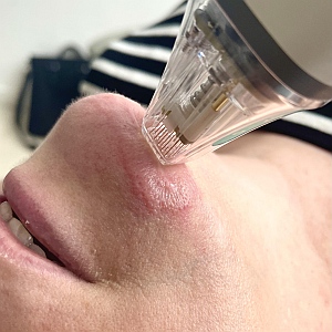 Radiofréquence fractionnée Microneedling POTENZA®