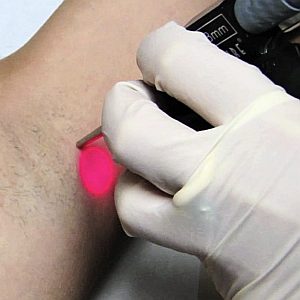 Epilation laser